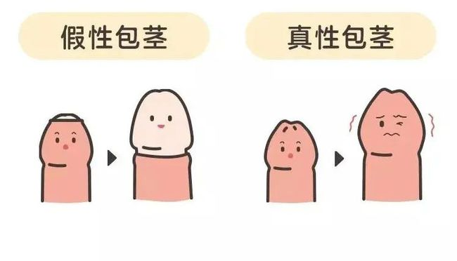 今日健康：南通专业看男科病医院“男科排名”包皮包茎的主要类型有哪些？